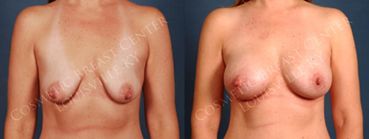 Lift Before & After Gallery - Patient 375620 - Image 1
