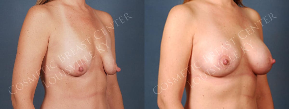 Lift Before & After Gallery - Patient 375620 - Image 2