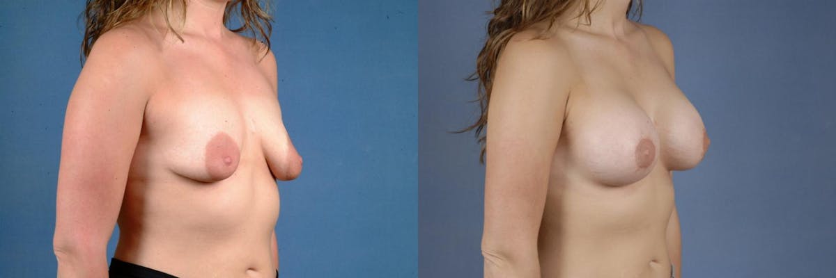 Lift Before & After Gallery - Patient 148417 - Image 2