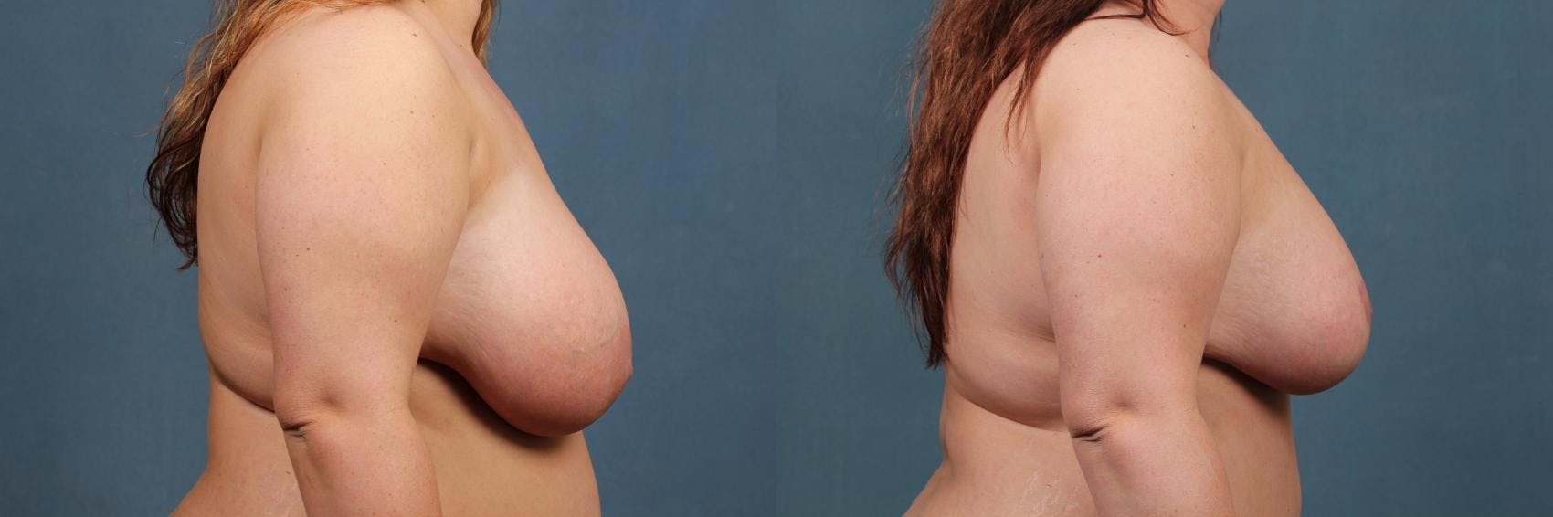Lift Before & After Gallery - Patient 238613 - Image 3