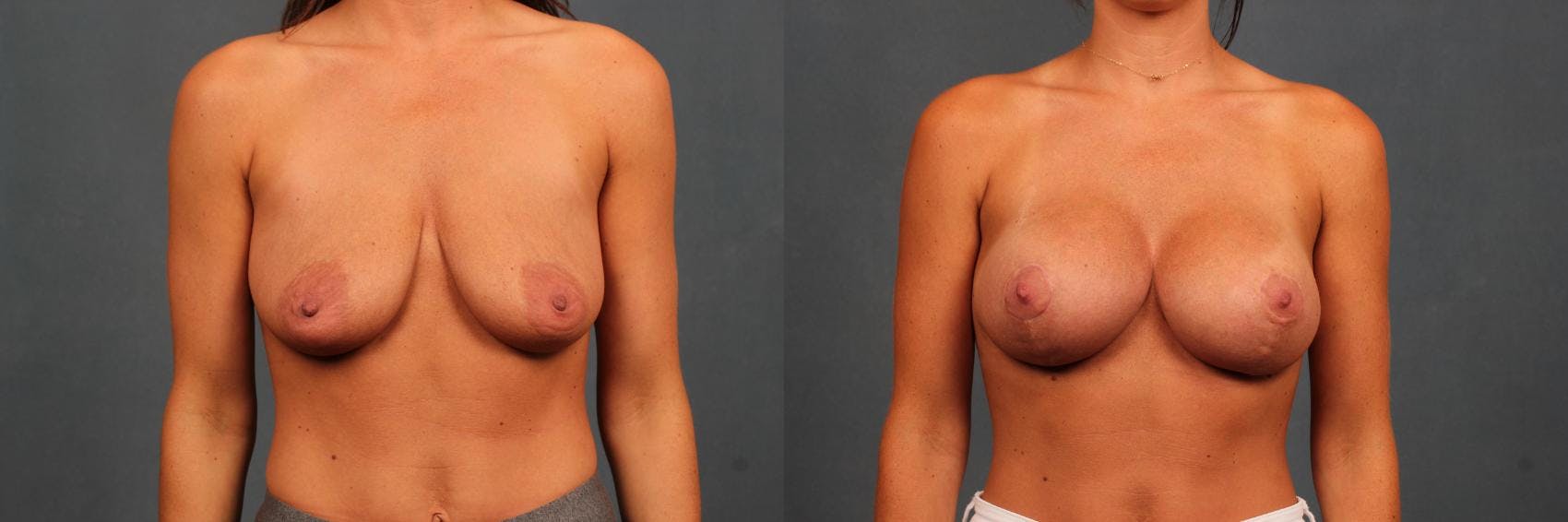 Lift Before & After Gallery - Patient 390602 - Image 1