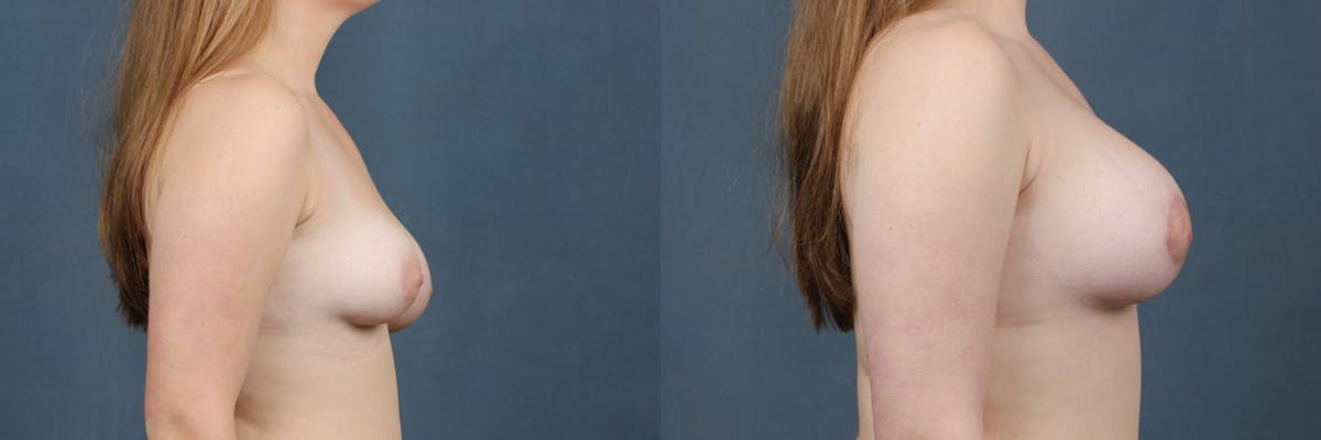 Lift Before & After Gallery - Patient 562793 - Image 3