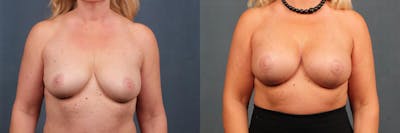 Lift Before & After Gallery - Patient 238088 - Image 1