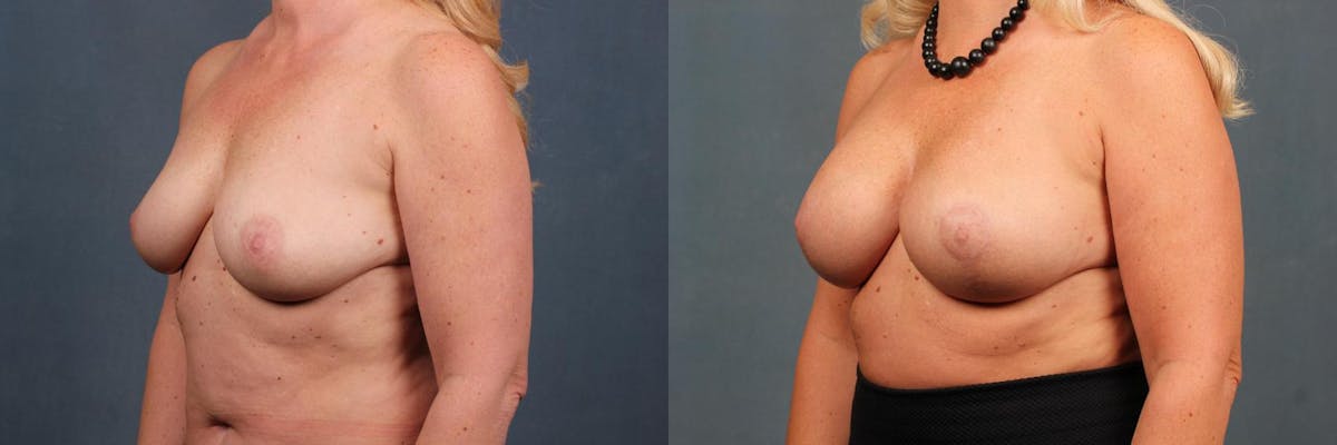 Lift Before & After Gallery - Patient 238088 - Image 2