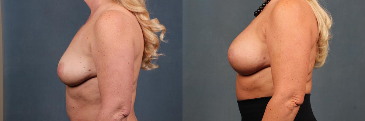 Lift Before & After Gallery - Patient 238088 - Image 3