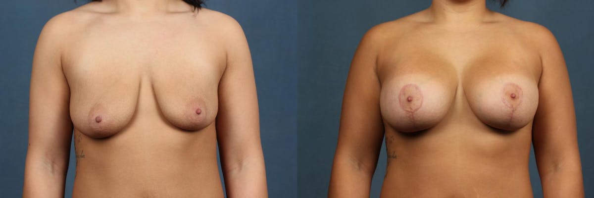 Lift Before & After Gallery - Patient 866757 - Image 1