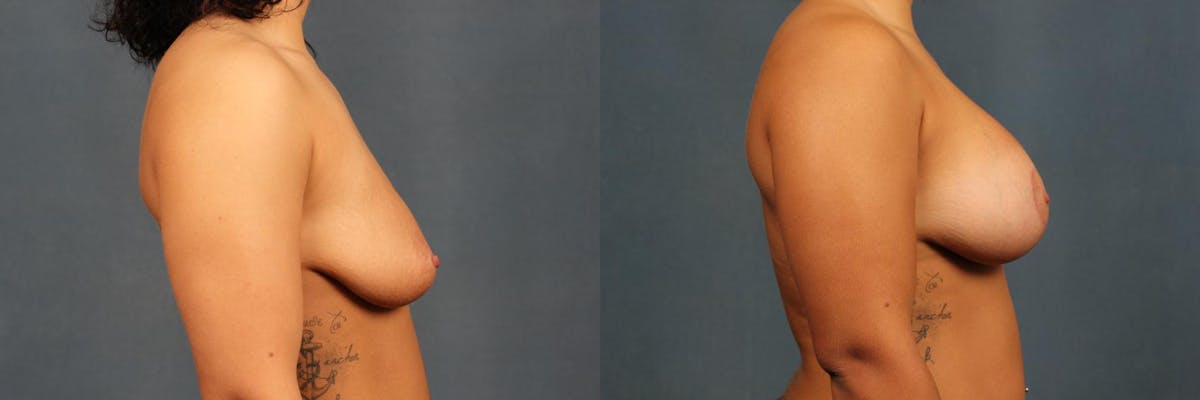 Lift Before & After Gallery - Patient 866757 - Image 3