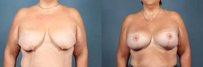 Lift Before & After Gallery - Patient 283865 - Image 1