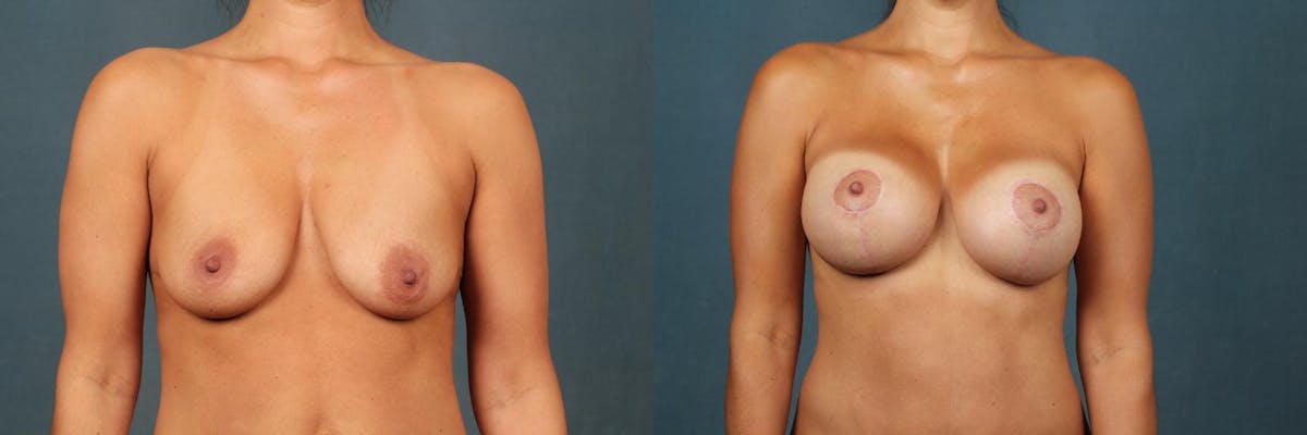 Lift Before & After Gallery - Patient 588533 - Image 1