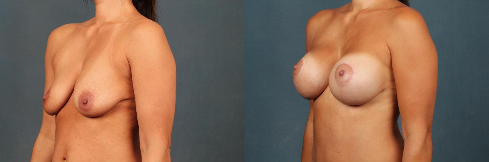 Lift Before & After Gallery - Patient 588533 - Image 2