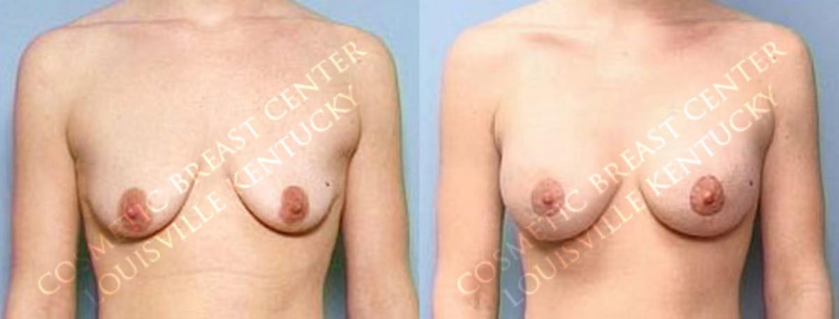 Lift Before & After Gallery - Patient 543824 - Image 1