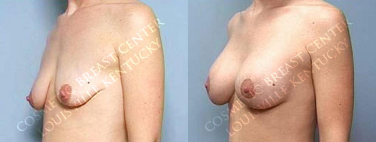 Lift Before & After Gallery - Patient 543824 - Image 2