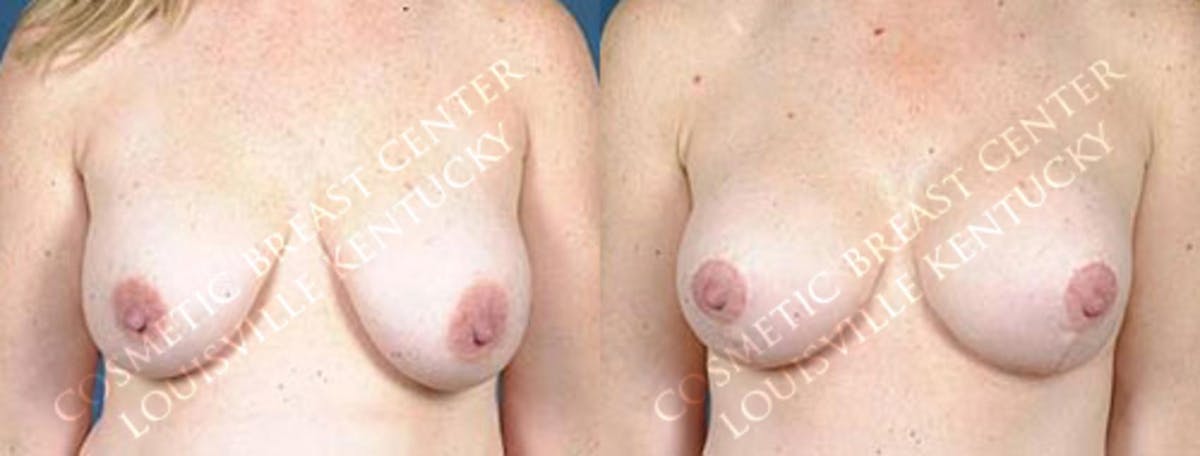 Lift Before & After Gallery - Patient 361223 - Image 1