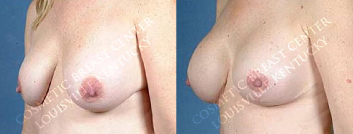 Lift Before & After Gallery - Patient 361223 - Image 2