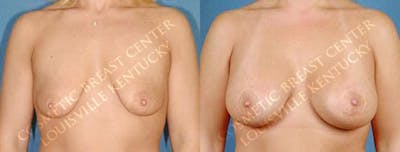 Lift Before & After Gallery - Patient 223830 - Image 1