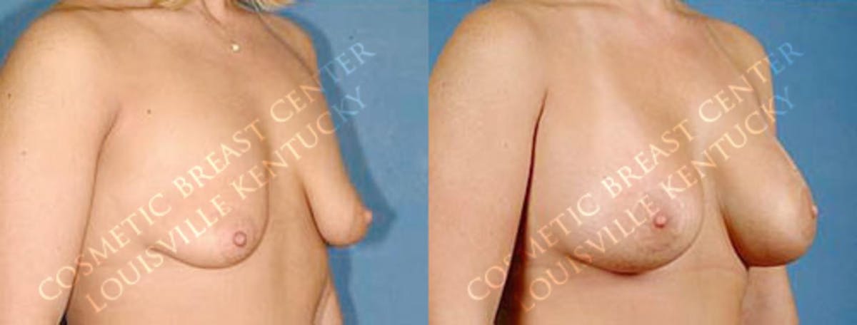 Lift Before & After Gallery - Patient 223830 - Image 2