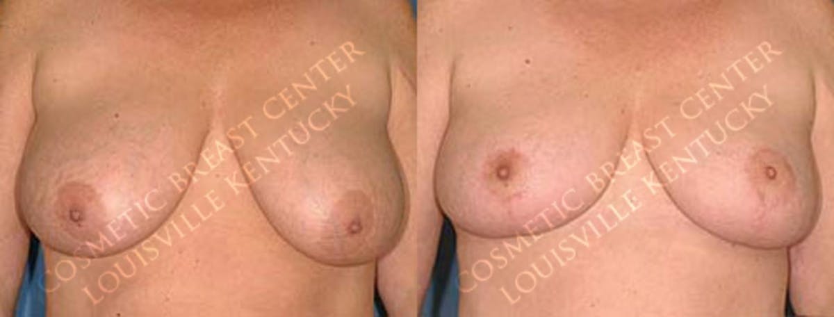 Lift Before & After Gallery - Patient 335452 - Image 1