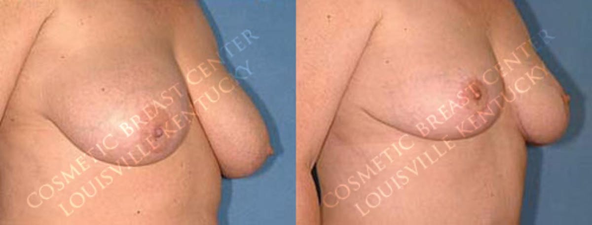 Lift Before & After Gallery - Patient 335452 - Image 2