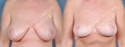 Lift Before & After Gallery - Patient 362008 - Image 1