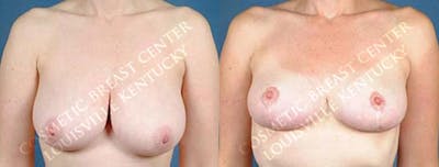 Lift Before & After Gallery - Patient 394353 - Image 1