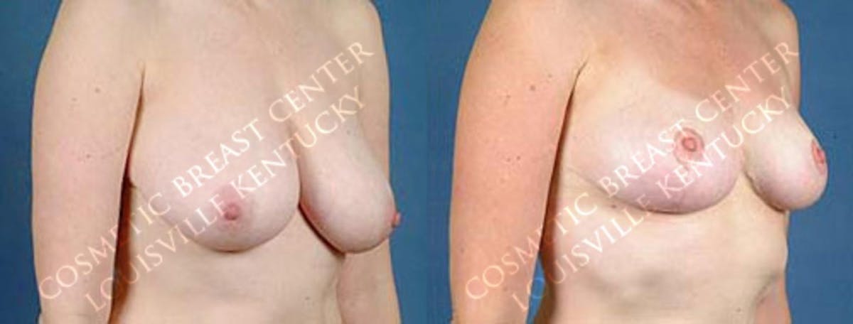 Lift Before & After Gallery - Patient 394353 - Image 2