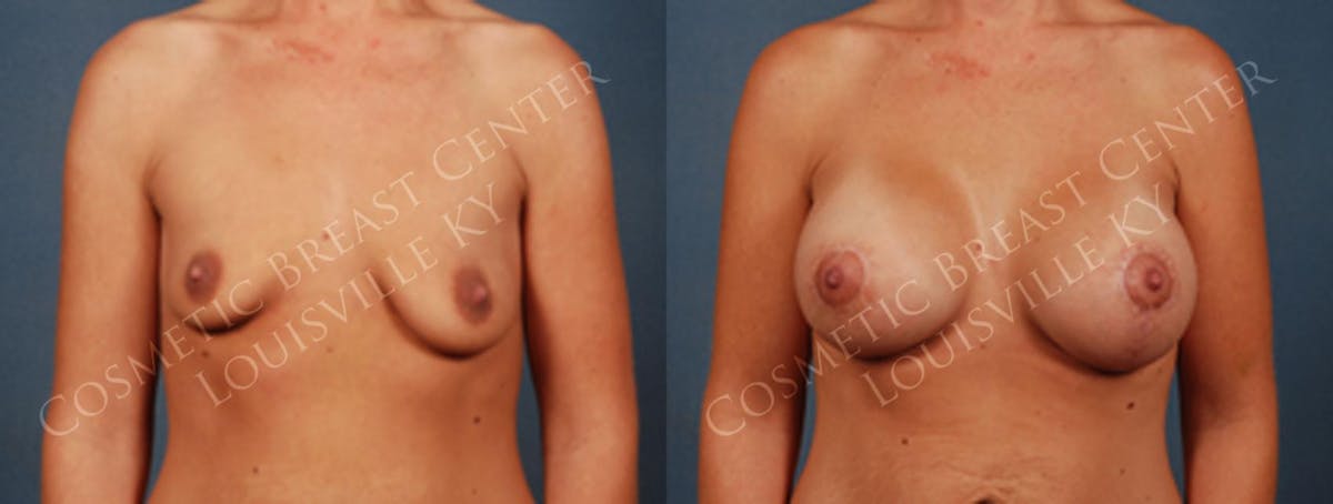 Lift Before & After Gallery - Patient 338606 - Image 1