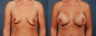 Lift Before & After Gallery - Patient 338606 - Image 1
