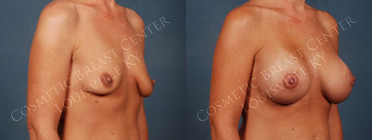 Lift Before & After Gallery - Patient 338606 - Image 2