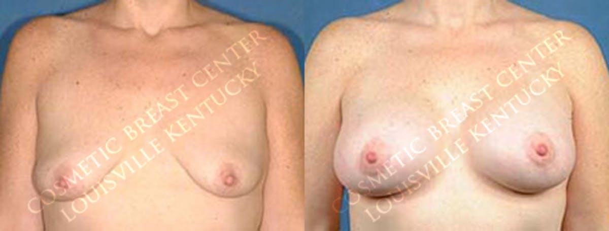 Lift Before & After Gallery - Patient 409083 - Image 1