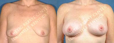 Lift Before & After Gallery - Patient 409083 - Image 1