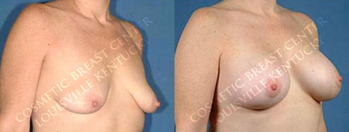 Lift Before & After Gallery - Patient 409083 - Image 2