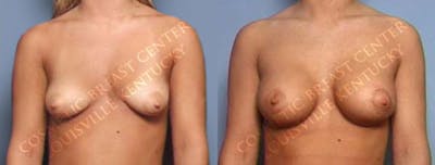 Lift Before & After Gallery - Patient 298327 - Image 1