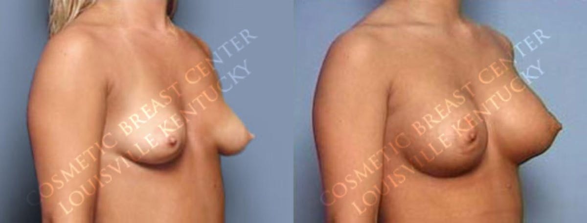 Lift Before & After Gallery - Patient 298327 - Image 2