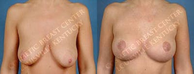 Lift Before & After Gallery - Patient 422829 - Image 1
