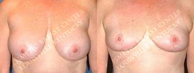 Lift Before & After Gallery - Patient 285035 - Image 1