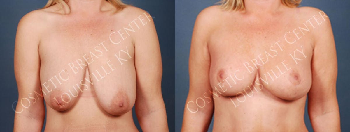 Lift Before & After Gallery - Patient 152636 - Image 1