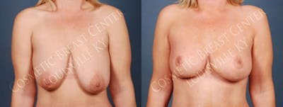 Lift Before & After Gallery - Patient 152636 - Image 1