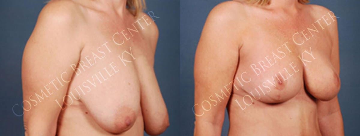 Lift Before & After Gallery - Patient 152636 - Image 2