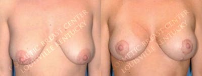 Lift Before & After Gallery - Patient 858686 - Image 1