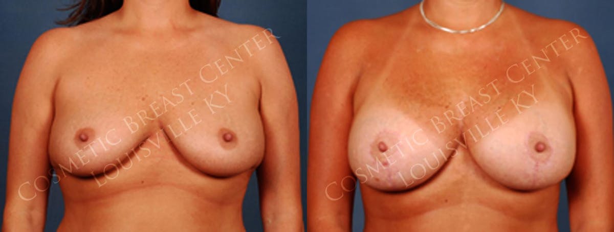 Lift Before & After Gallery - Patient 145960 - Image 1