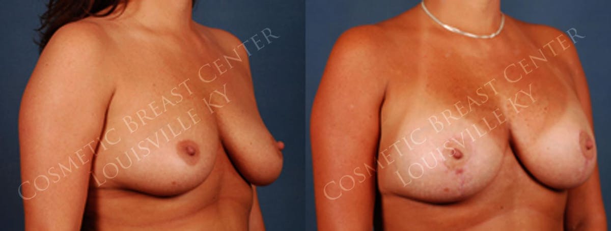 Lift Before & After Gallery - Patient 145960 - Image 2