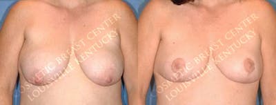 Lift Before & After Gallery - Patient 596406 - Image 1