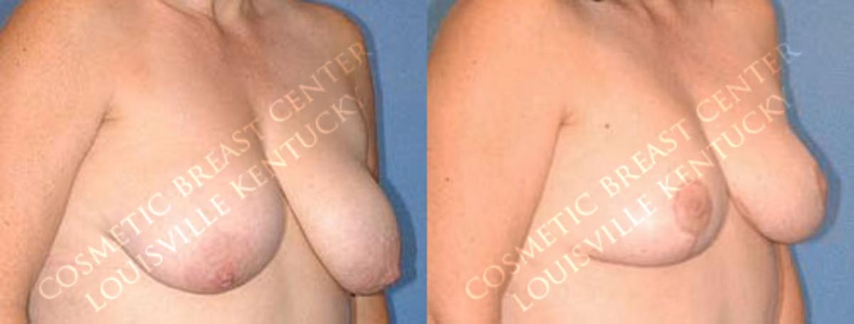 Lift Before & After Gallery - Patient 596406 - Image 2