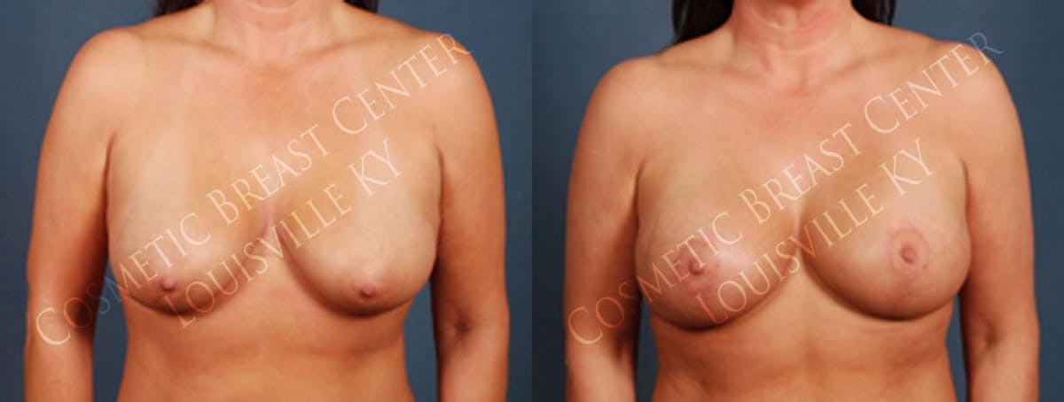 Lift Before & After Gallery - Patient 274705 - Image 1