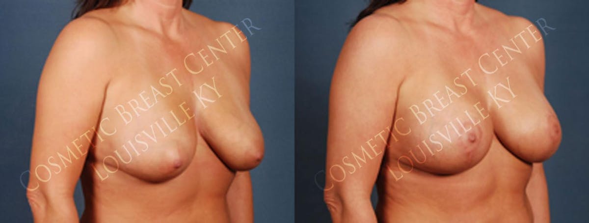 Lift Before & After Gallery - Patient 274705 - Image 2