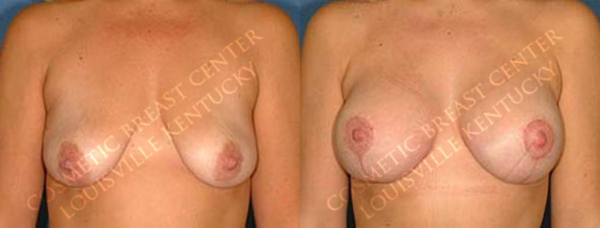 Lift Before & After Gallery - Patient 399435 - Image 1