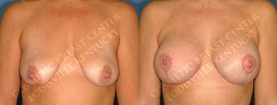 Lift Before & After Gallery - Patient 399435 - Image 1