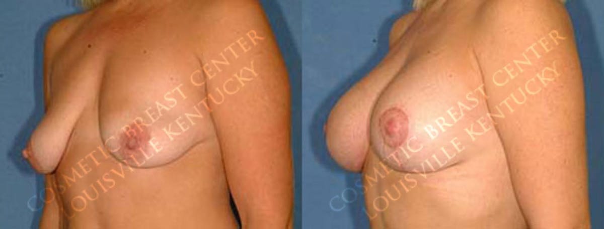 Lift Before & After Gallery - Patient 399435 - Image 2