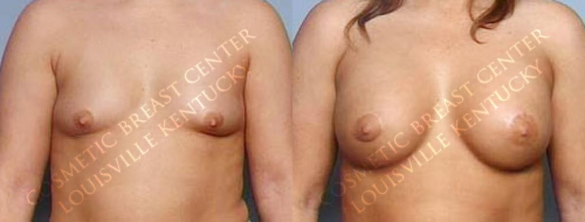 Lift Before & After Gallery - Patient 248337 - Image 1