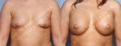 Lift Before & After Gallery - Patient 248337 - Image 1